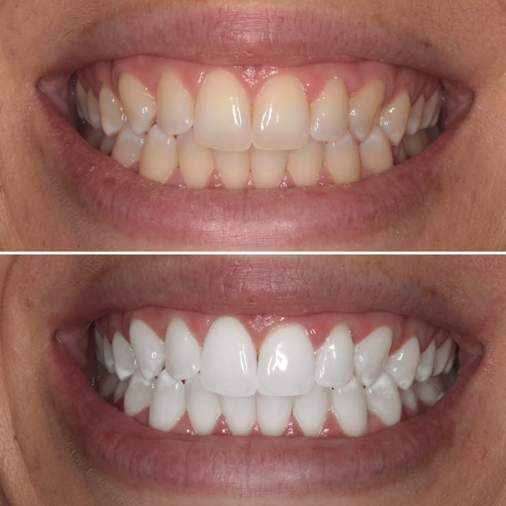 Teeth Brightening Strips