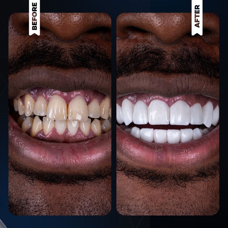 Teeth Brightening Strips